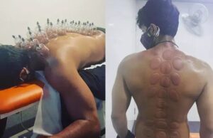 முதுகில் வட்ட வட்டமா இருக்கு: கப்பிங் தெரபி செய்து கொண்ட விஷ்ணு விஷால்!