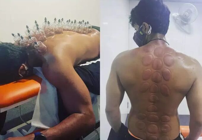 முதுகில் வட்ட வட்டமா இருக்கு: கப்பிங் தெரபி செய்து கொண்ட விஷ்ணு விஷால்!